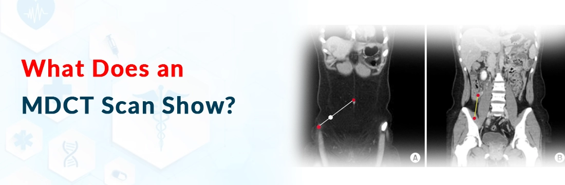 What Does an MDCT Scan Show?
